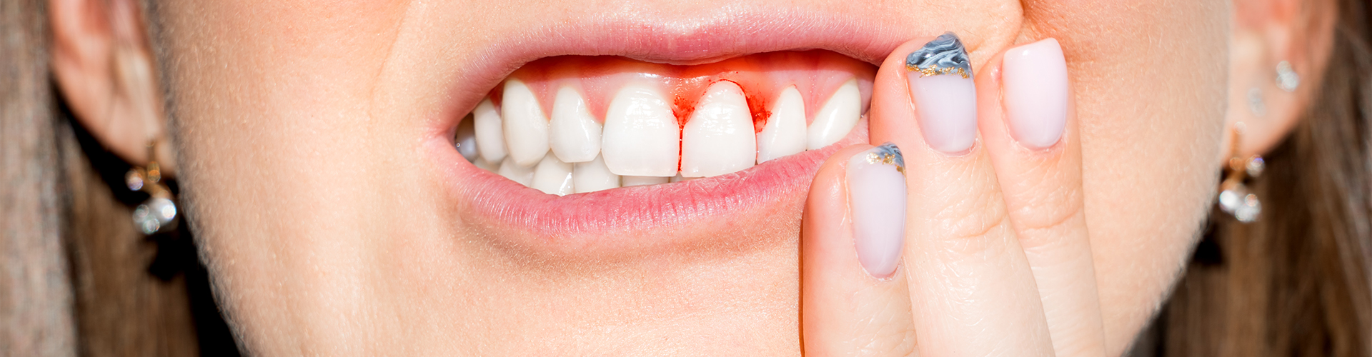 Mouth with inflamed gums.